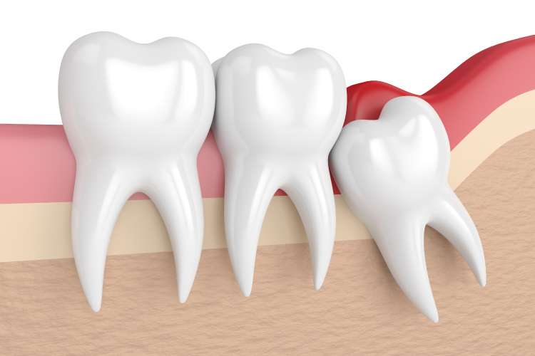 Graphic of a misaligned wisdom tooth that's needs to be extracted