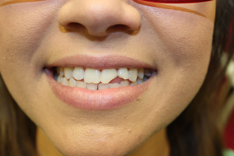 Closeup of a smile with a chipped tooth