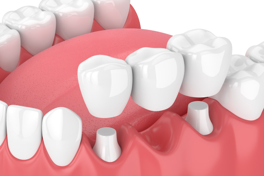 Model showing a three tooth dental bridge