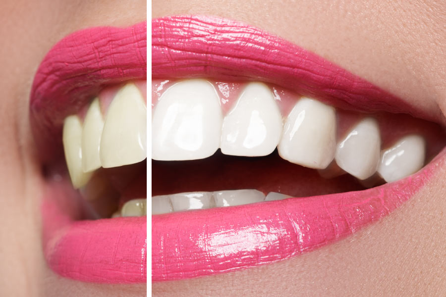 Close up of a smile with bright pink lipstick showing before and after professional teeth whitening