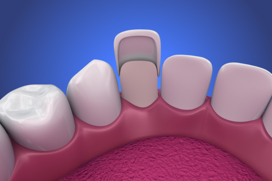 Model of a porcelain veneer.