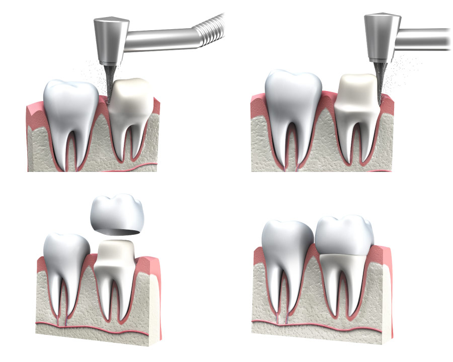 Images showing the steps to prepare for a dental crown.