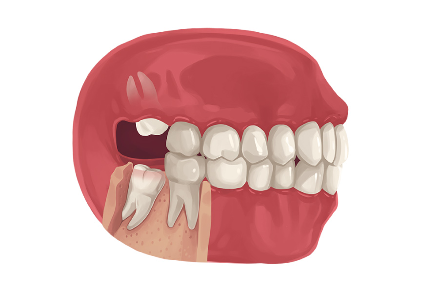 Model of a mouth showing wisdom teeth growing in at bad angles.