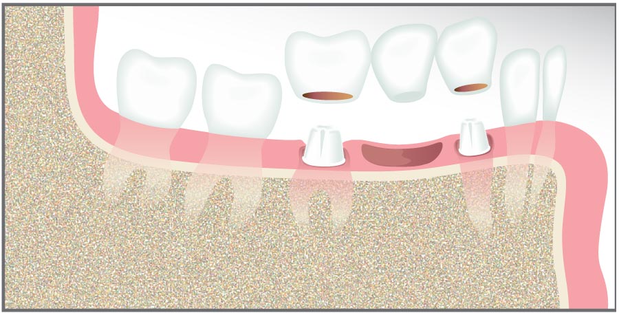 Graphic showing one type of dental bridge.