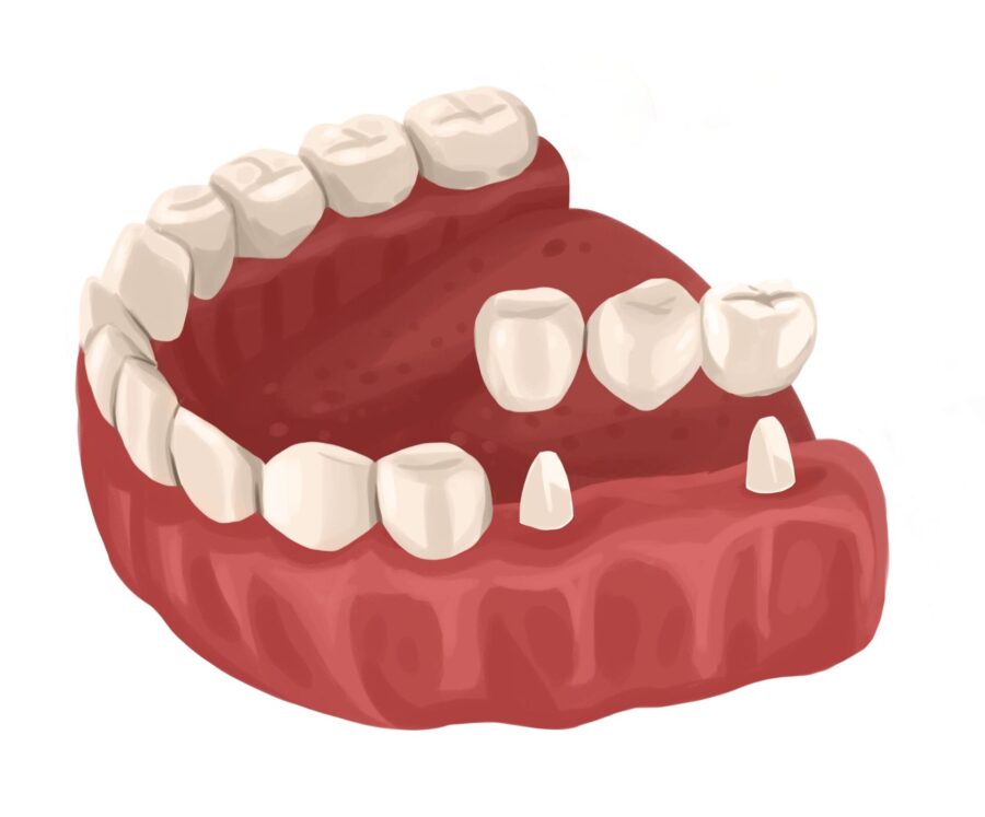 dental bridges