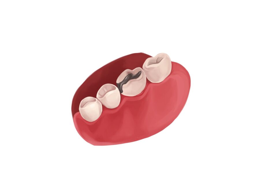 Graphic illustration of amalgam silver dental fillings. 