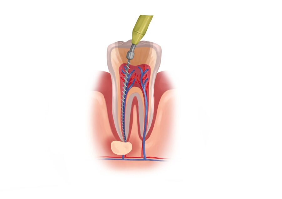medically accurate graphic illustration of root canal treatment, root canal therapy