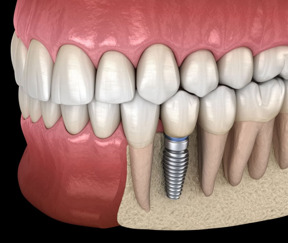 dental implant